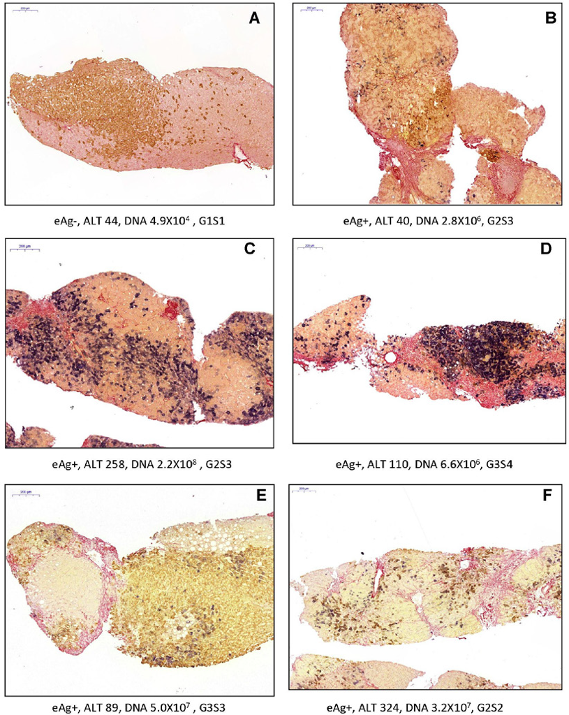 图3 hbv dna(褐色,hbsag(棕色)和天狼星红三重染色的典型图像 讨论